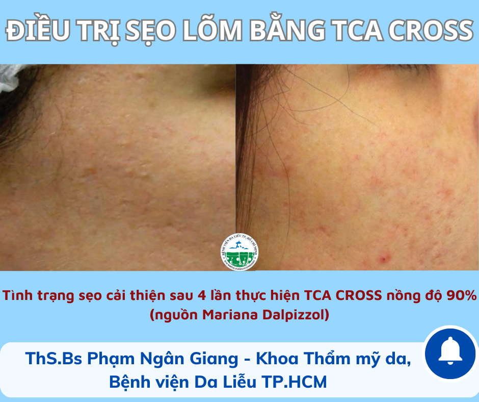 bvdl-ky-thuat-tca-cross-bs-ngan-giang