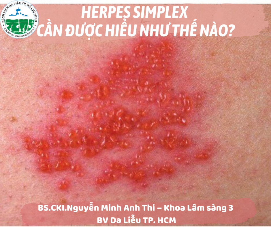 herpes-simplex-bs-thi