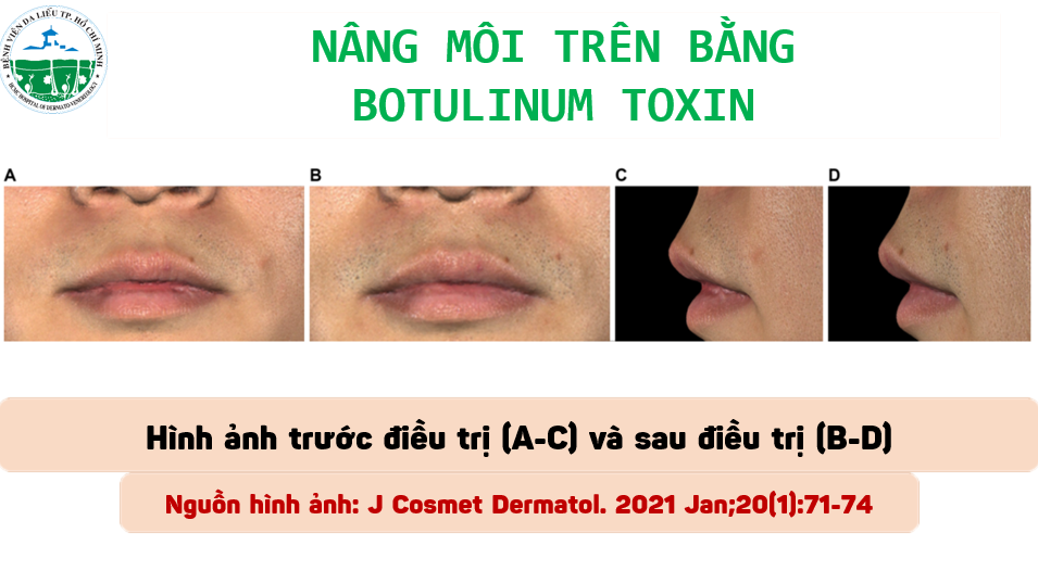 nang-moi-tren-bang-botox-3-up