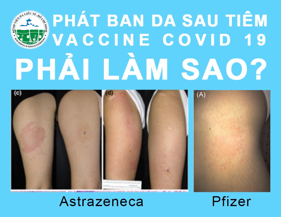 phat-ban-da-sau-tiem-vaccine-covid
