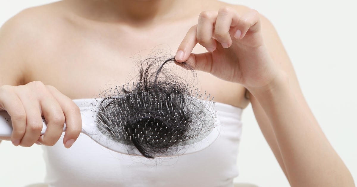 Phát hiện mắc giang mai giai đoạn 2 khi đi khám rụng tóc